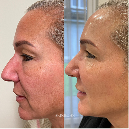 Skinboss - Ageing - Before & After