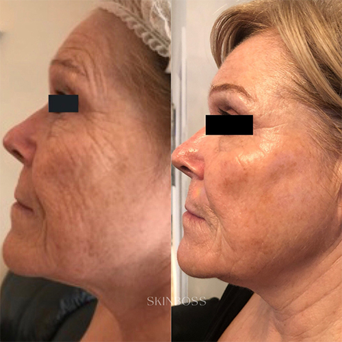 Skinboss - Ageing - Before & After