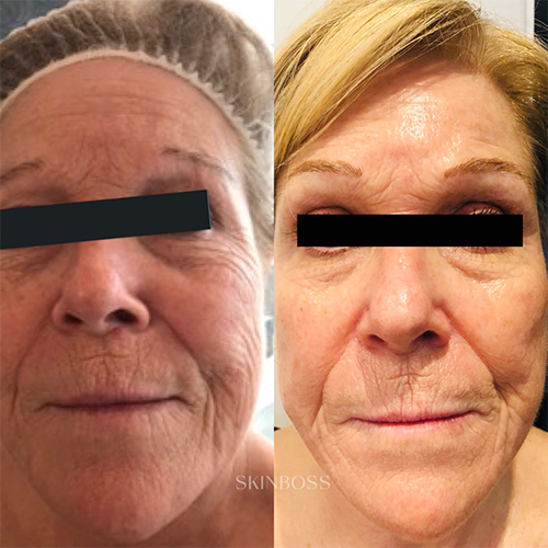 Skinboss - Ageing - Before & After