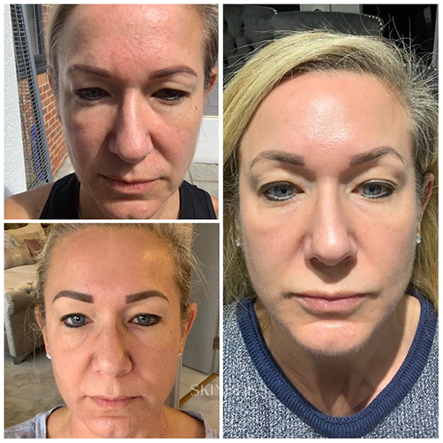 Skinboss - Ageing - Before & After