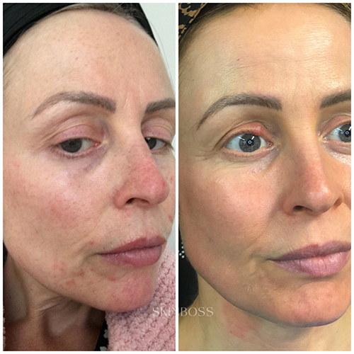 Skinboss - Ageing - Before & After