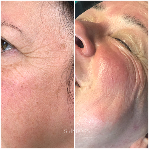 Skinboss - Ageing - Before & After