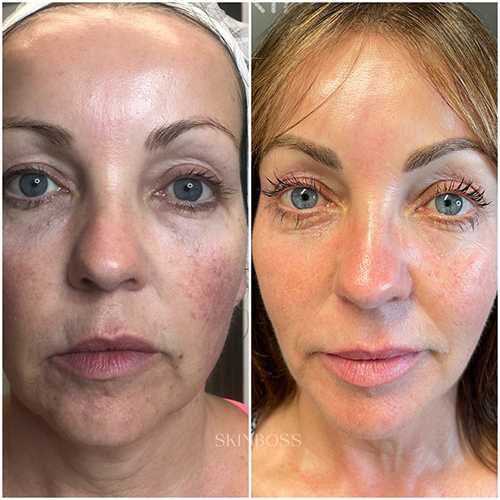 Skinboss - Ageing - Before & After