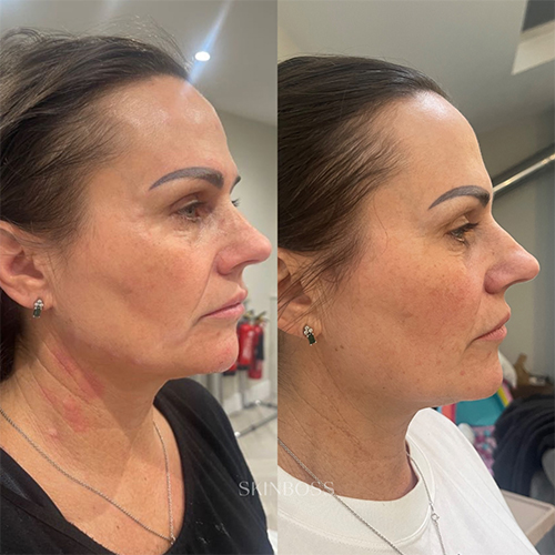 Skinboss - Ageing - Before & After