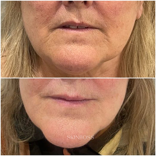 Skinboss - Ageing - Before & After