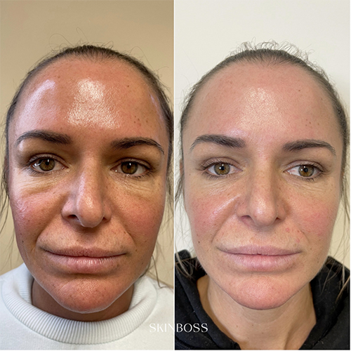 Skinboss - Ageing - Before & After