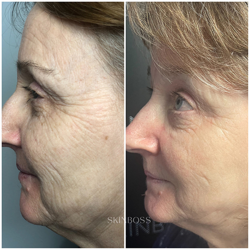 Skinboss - Ageing - Before & After