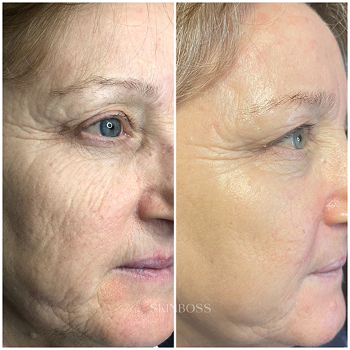 Skinboss - Ageing - Before & After