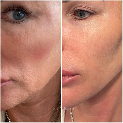 Skinboss - Ageing - Before & After