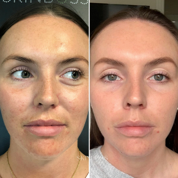 Skinboss - Case Study - Courtney Cheek