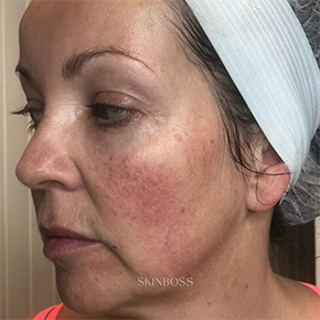 Skinboss - Case Study - Shelly Long