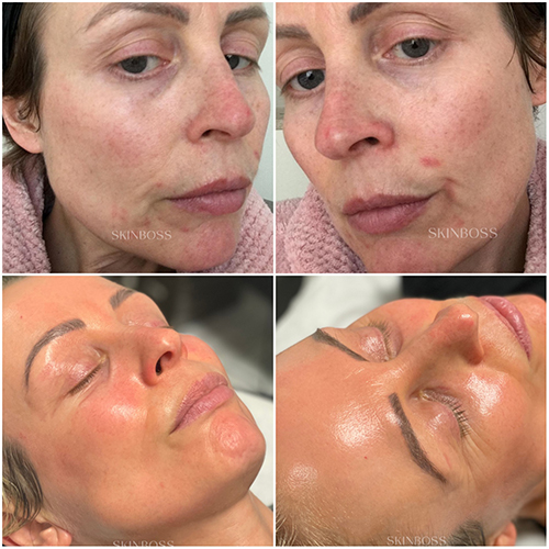 Skinboss - Complexion Correction - Before & After