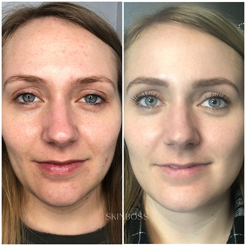 Skinboss - Complexion Correction - Before & After