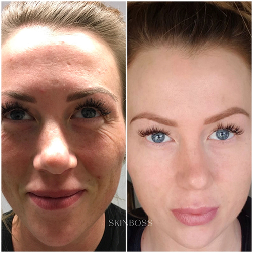 Skinboss - Complexion Correction - Before & After