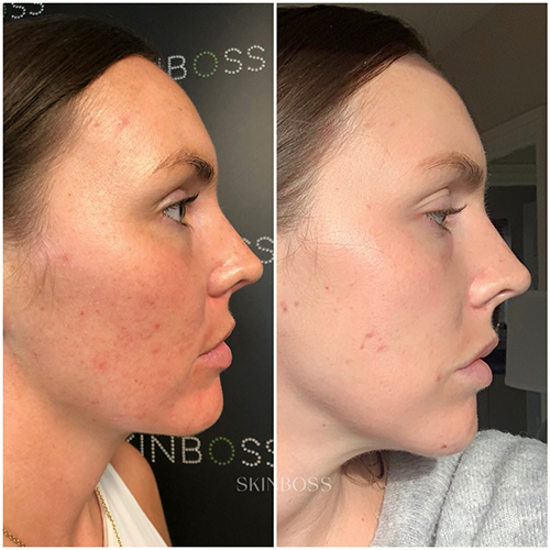 Skinboss - Complexion Correction - Before & After