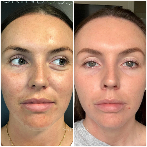 Skinboss - Complexion Correction - Before & After