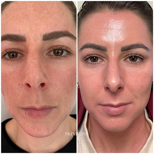 Skinboss - Complexion Correction - Before & After