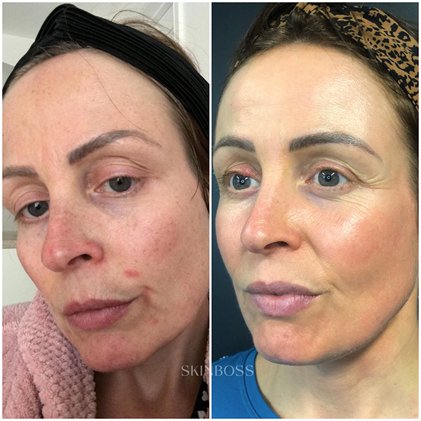 Skinboss - Complexion Correction - Before & After