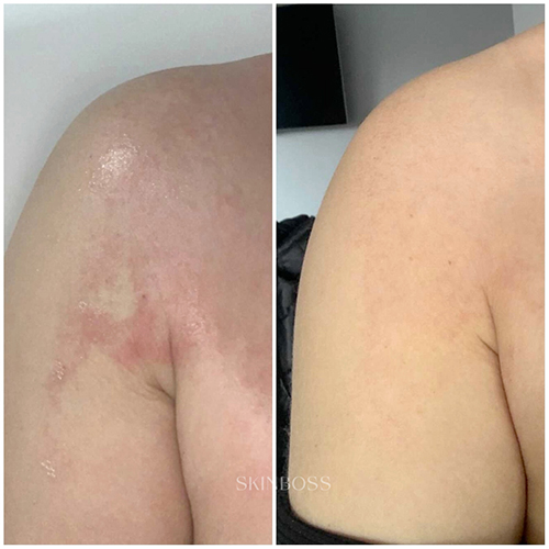 Skinboss - Eczema & Psoriasis - Before & After