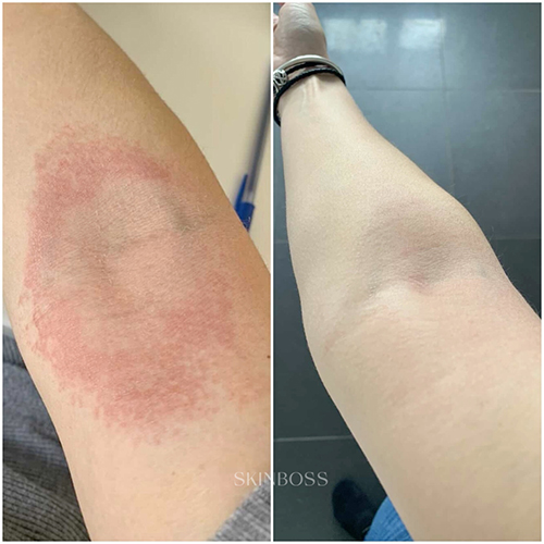 Skinboss - Eczema & Psoriasis - Before & After