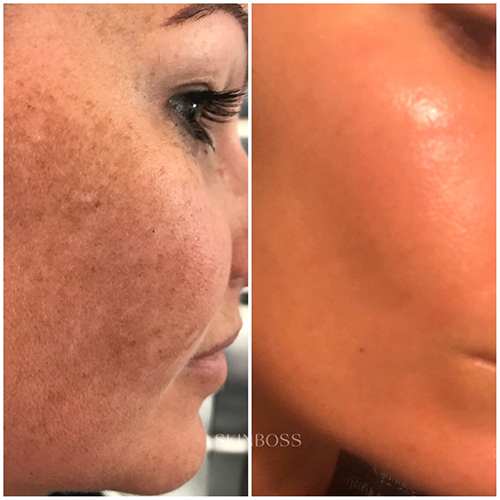 Skinboss - Hyperpigmentation & Melasma - Before & After