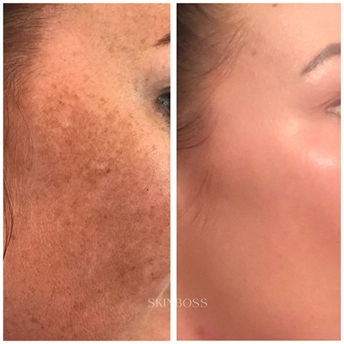 Skinboss - Hyperpigmentation & Melasma - Before & After