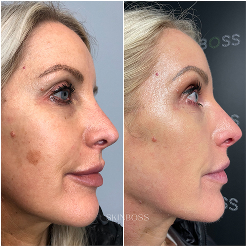 Skinboss - Hyperpigmentation & Melasma - Before & After