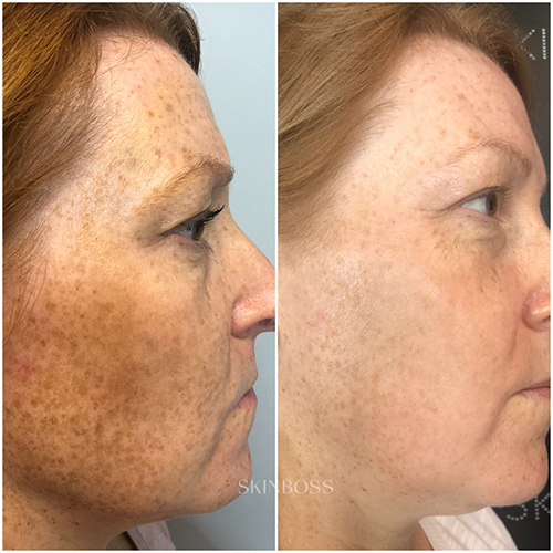 Skinboss - Hyperpigmentation & Melasma - Before & After