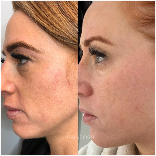 Skinboss - Hyperpigmentation & Melasma - Before & After