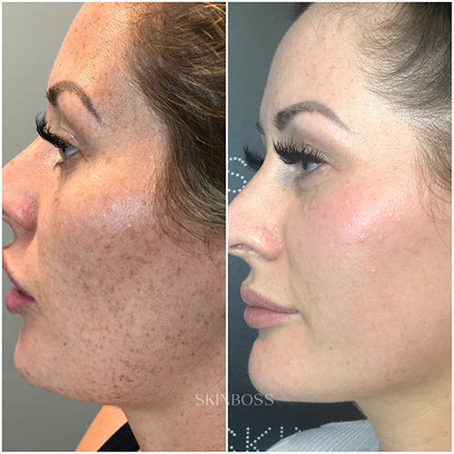 Skinboss - Hyperpigmentation & Melasma - Before & After