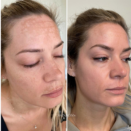 Skinboss - Hyperpigmentation & Melasma - Before & After