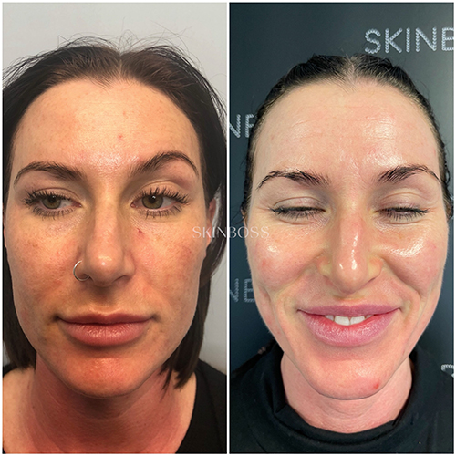 Skinboss - Hyperpigmentation & Melasma - Before & After