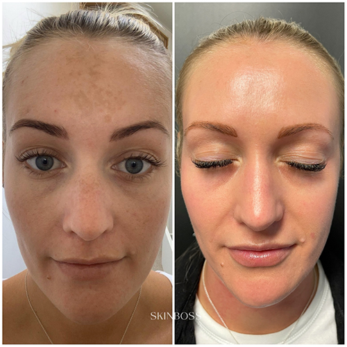 Skinboss - Hyperpigmentation & Melasma - Before & After