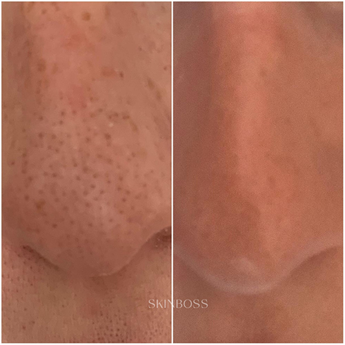 Skinboss - Pore & Texture Correction - Before & After