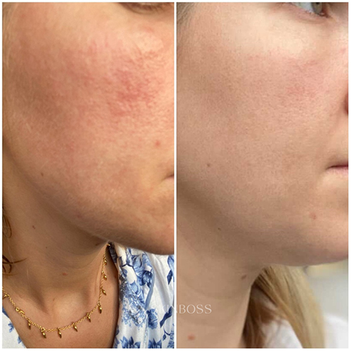 Skinboss - Pore & Texture Correction - Before & After