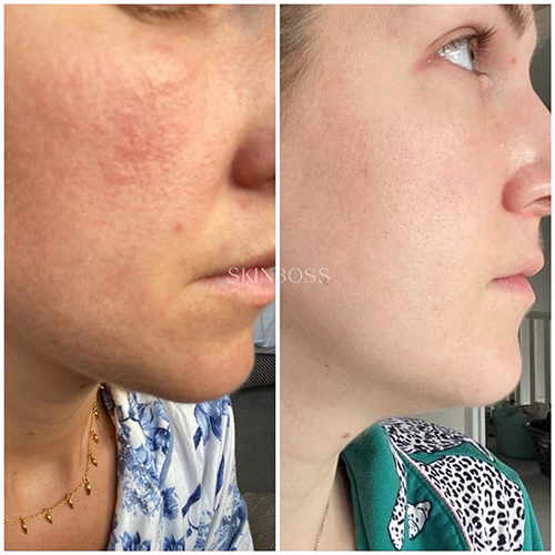 Skinboss - Pore & Texture Correction - Before & After