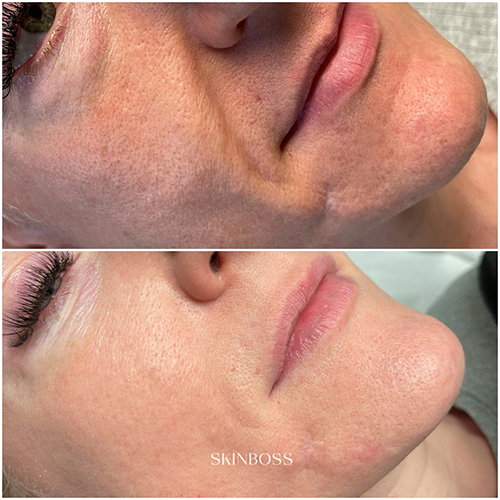 Skinboss - Pore & Texture Correction - Before & After