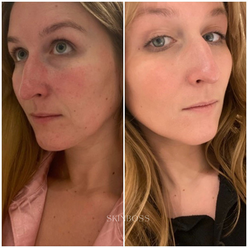 Skinboss - Rosacea & Redness - Before & After