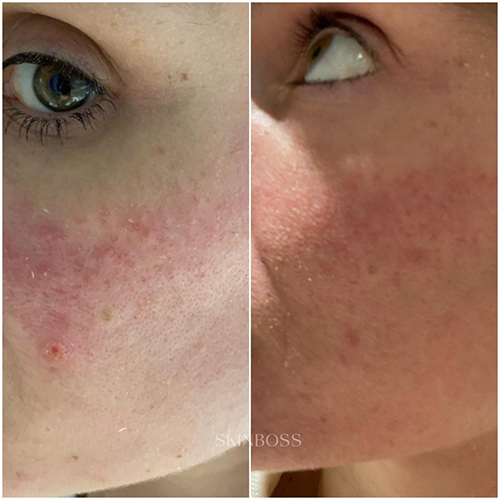 Skinboss - Rosacea & Redness - Before & After