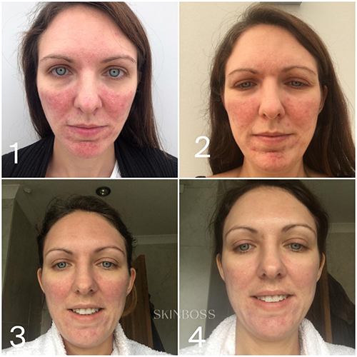 Skinboss - Rosacea & Redness - Before & After