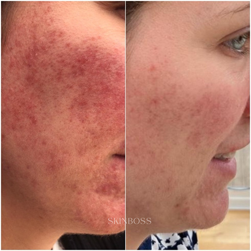 Skinboss - Rosacea & Redness - Before & After