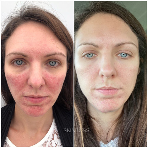 Skinboss - Rosacea & Redness - Before & After