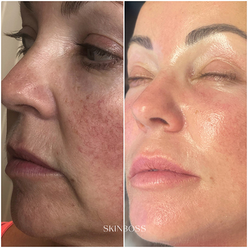 Skinboss - Rosacea & Redness - Before & After