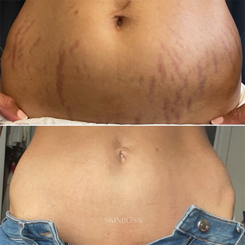 Skinboss - Stretch Marks - Before & After